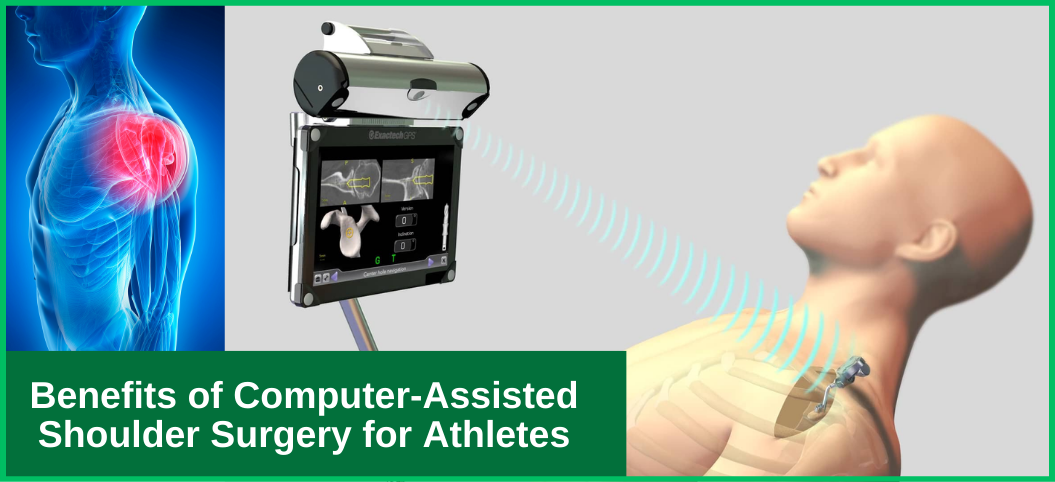 Benefits of Computer-Assisted Shoulder Surgery for Athletes