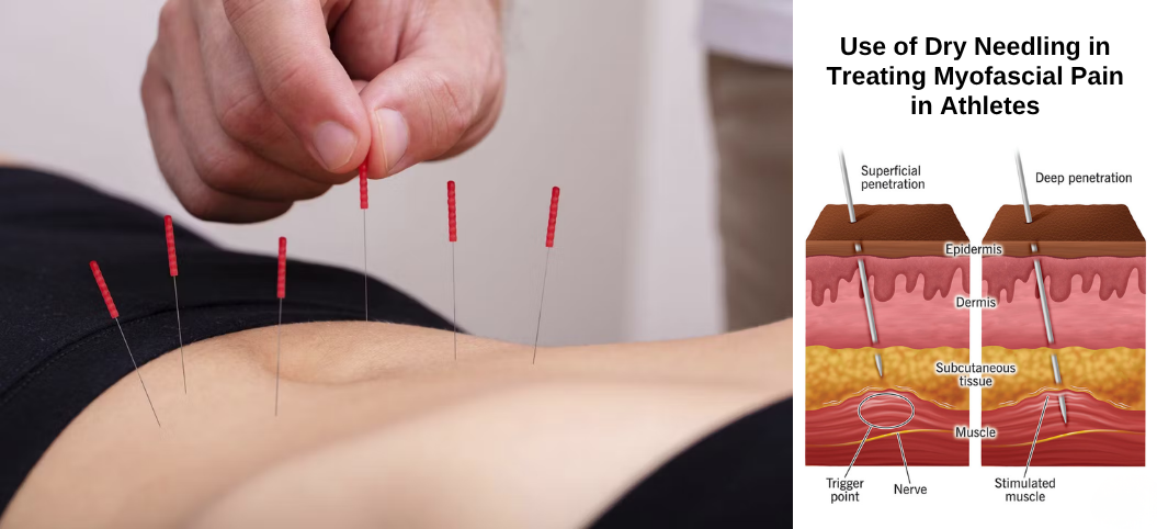 Use of Dry Needling in Treating Myofascial Pain in Athletes
