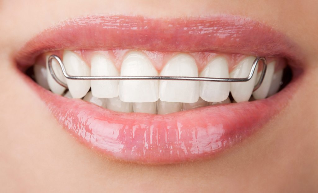 What Are Retainers?